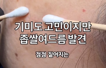 평생 점인줄 아셨다는 고객님 시원하게 추출해드렸어요^^ 투은희뷰티라운지 문의는 01076802163